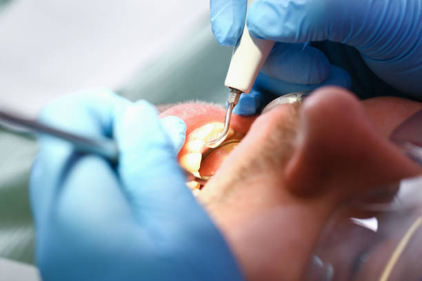 Best Chipped Tooth Repair Near Me  in Land O Lakes, FL