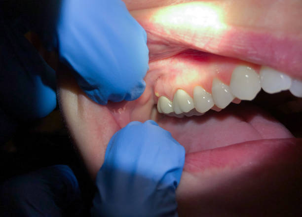 Best Knocked-Out Tooth Emergency  in Land O Lakes, FL